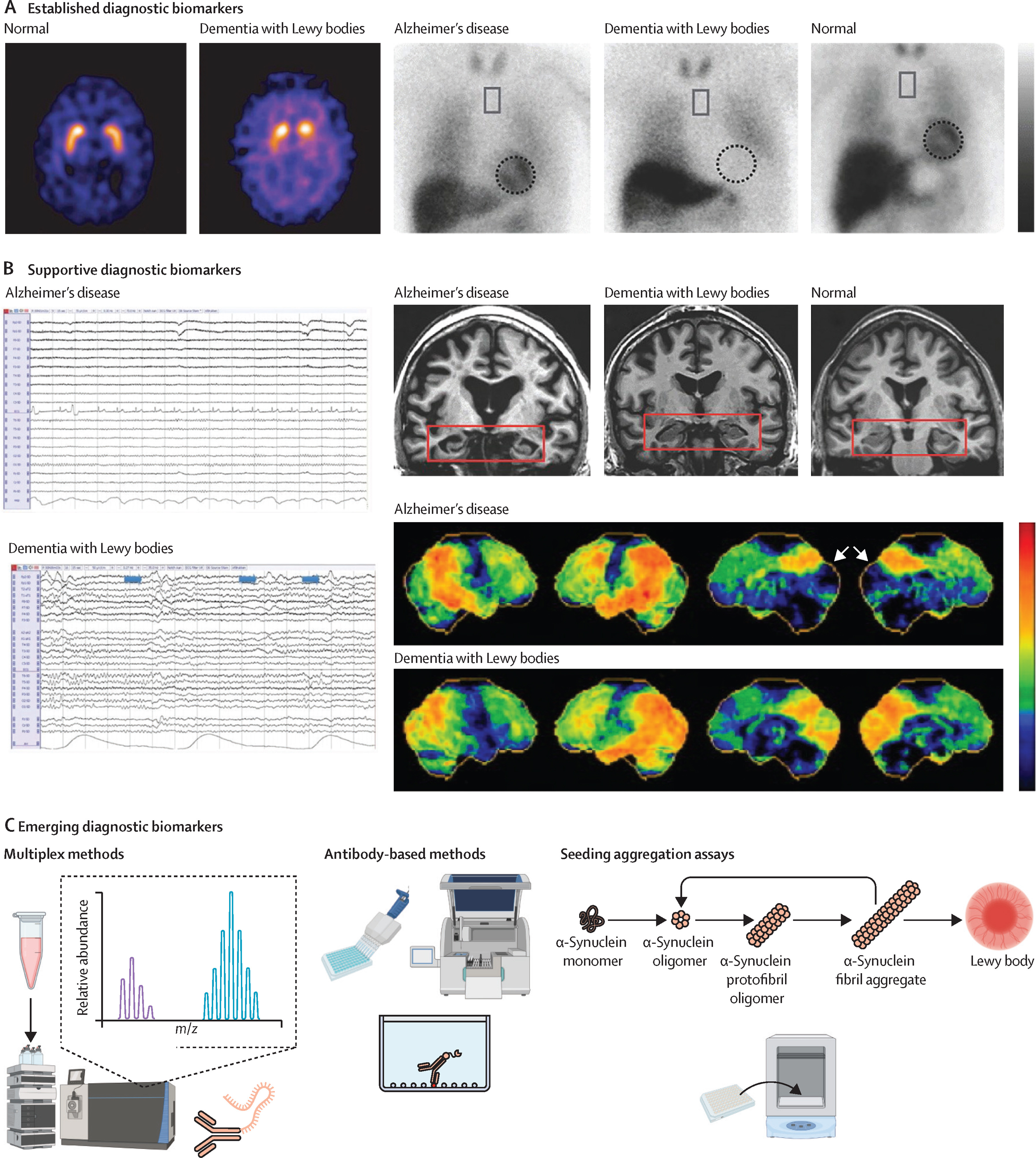 7 Stages Lewy Body Dementia