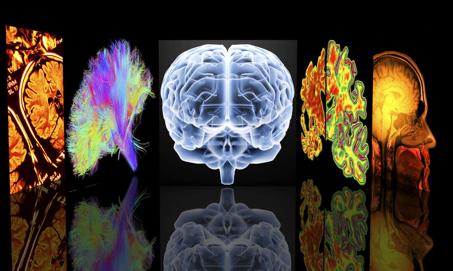 dementia onset comparison