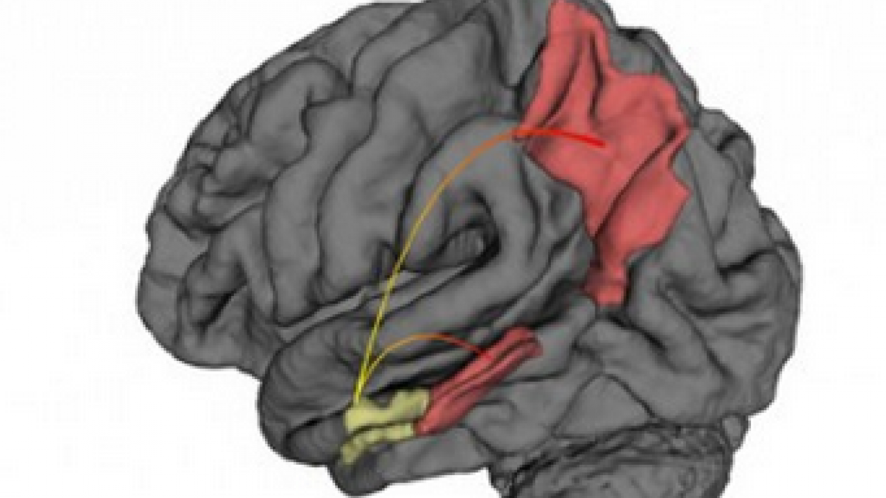 Diagram of a human brain with highlighted areas showing the regions affected by dementia